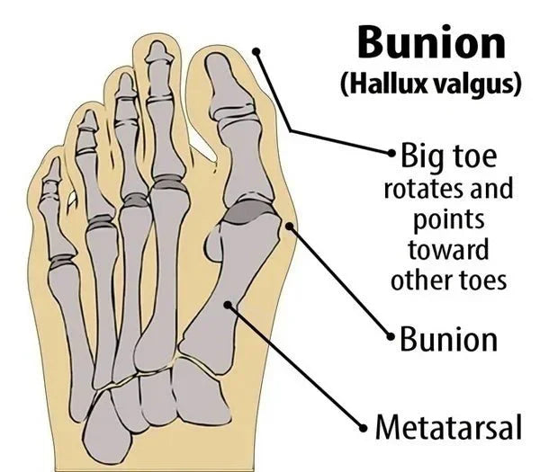 Zehentrenner-Socken, Daumenversteller, Haarglätter, Fußknochen-Orthopädie, Hallux-Valgus-Schiene, Ärmel, Ballenzehen-Korrektor